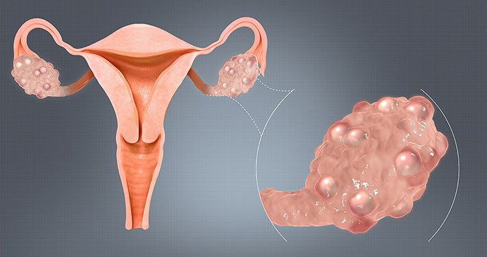 Best gynecologist in Chennai for PCOS